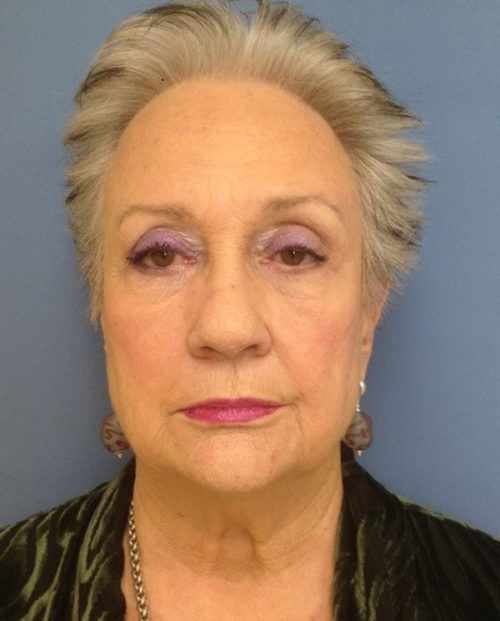 Face & Neck Lift Case 854 Before Photo Face & Neck Lift
