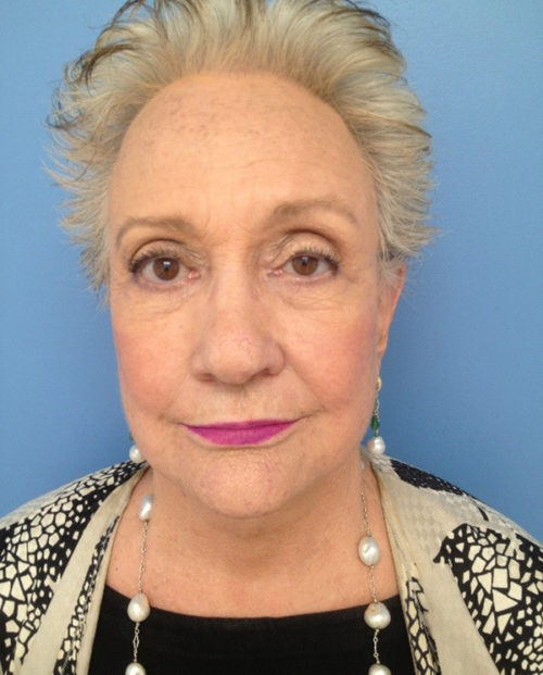 Face & Neck Lift Case 854 After Photo Face & Neck Lift