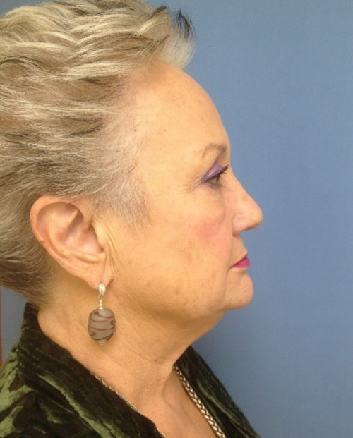 Face & Neck Lift Case 854 Before Photo Face & Neck Lift