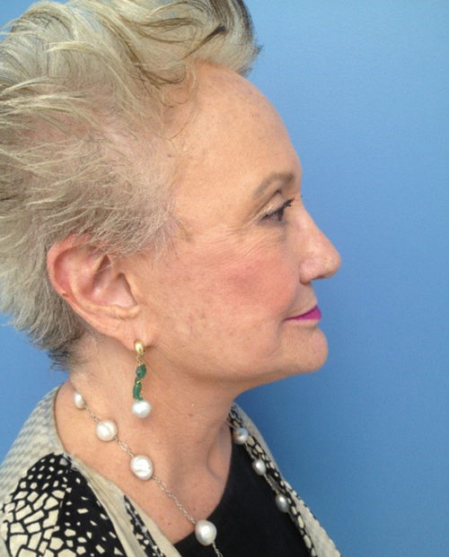 Face & Neck Lift Case 854 After Photo Face & Neck Lift