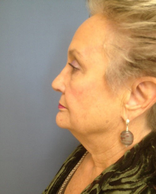 Face & Neck Lift Case 854 Before Photo Face & Neck Lift
