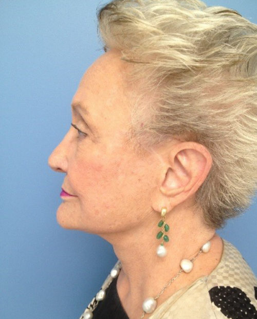 Face & Neck Lift Case 854 After Photo Face & Neck Lift