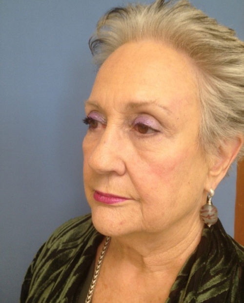 Face & Neck Lift Case 854 Before Photo Face & Neck Lift