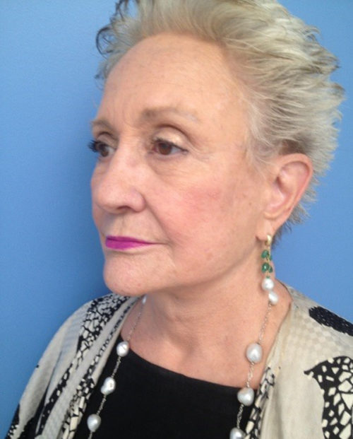 Face & Neck Lift Case 854 After Photo Face & Neck Lift