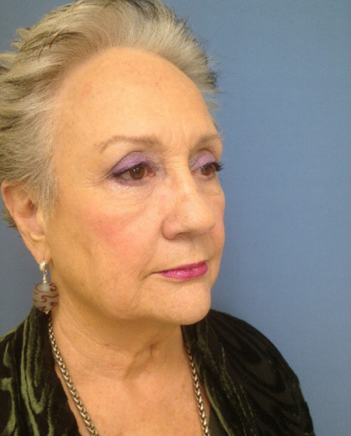 Face & Neck Lift Case 854 Before Photo Face & Neck Lift