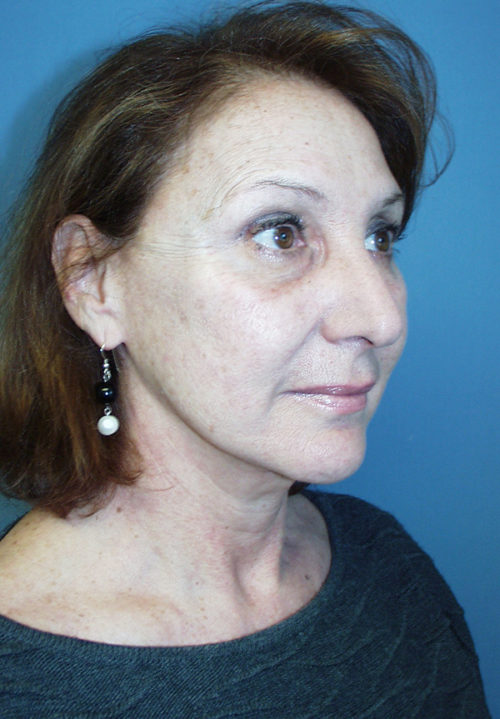 Face & Neck Lift Case 855 After Photo Face & Neck Lift