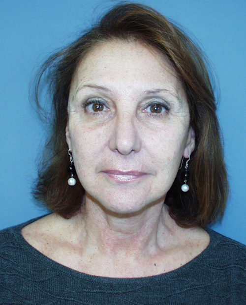 Face & Neck Lift Case 855 After Photo Face & Neck Lift