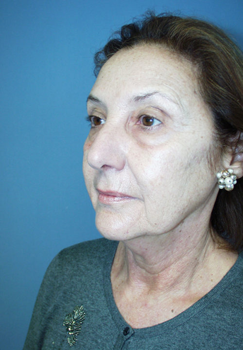 Face & Neck Lift Case 855 Before Photo Face & Neck Lift