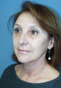 Face & Neck Lift