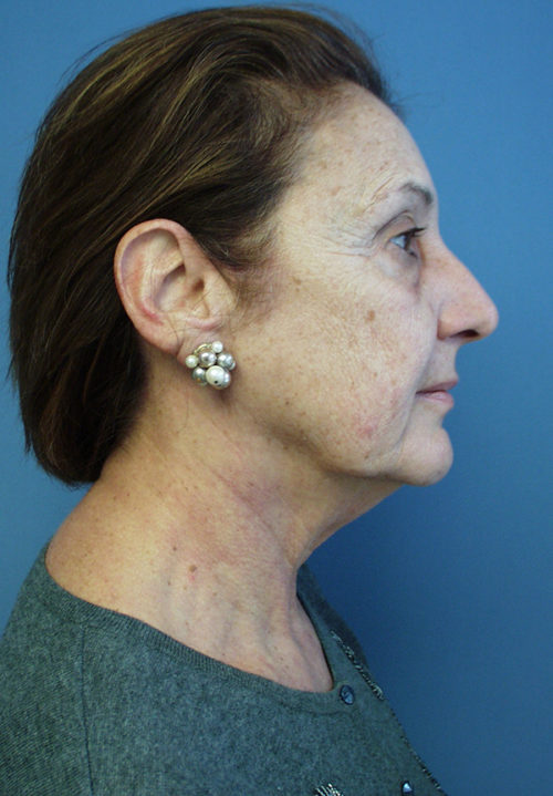 Face & Neck Lift Case 855 Before Photo Face & Neck Lift