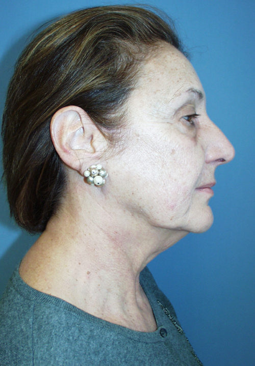 Face & Neck Lift Case 855 Before Photo Face & Neck Lift