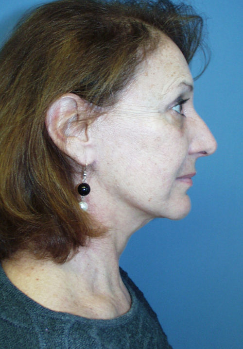 Face & Neck Lift Case 855 After Photo Face & Neck Lift