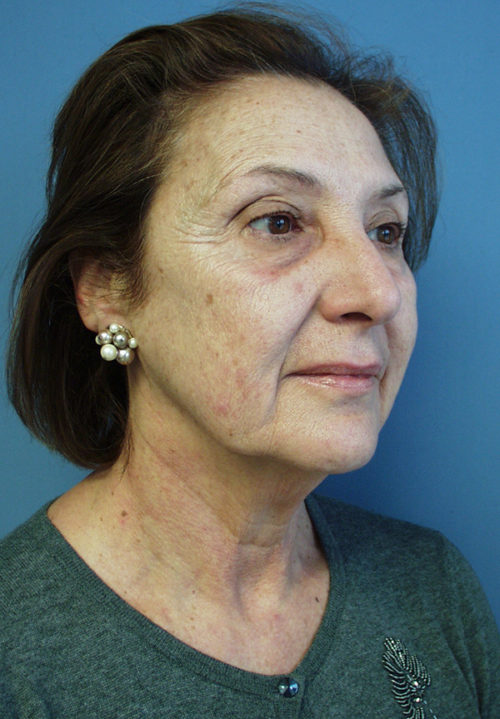 Face & Neck Lift Case 855 Before Photo Face & Neck Lift