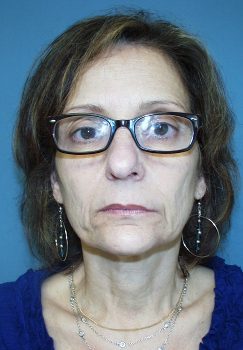 Face & Neck Lift Case 857 Before Photo Face & Neck Lift