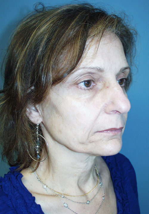 Face & Neck Lift Case 857 Before Photo Face & Neck Lift