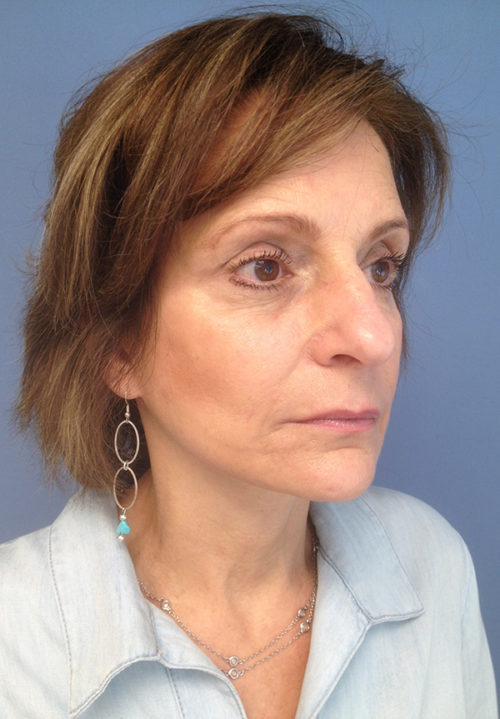 Face & Neck Lift Case 857 After Photo Face & Neck Lift
