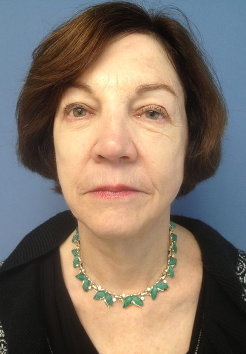Face & Neck Lift Case 856 After Photo Face & Neck Lift