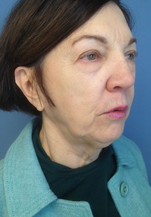 Face & Neck Lift Case 856 Before Photo Face & Neck Lift