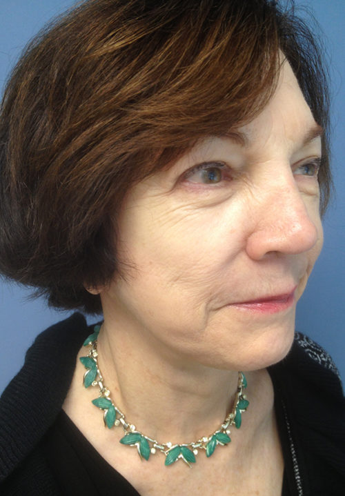 Face & Neck Lift Case 856 After Photo Face & Neck Lift