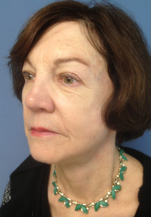 Face & Neck Lift Case 856 After Photo Face & Neck Lift