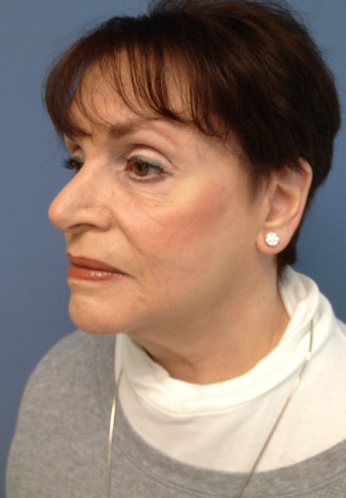 Face & Neck Lift Case 858 After Photo Face & Neck Lift
