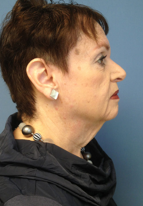 Face & Neck Lift Case 858 Before Photo Face & Neck Lift
