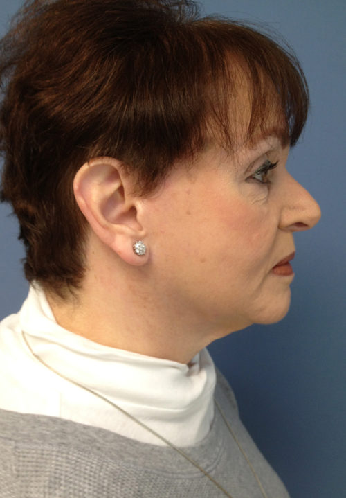 Face & Neck Lift Case 858 After Photo Face & Neck Lift