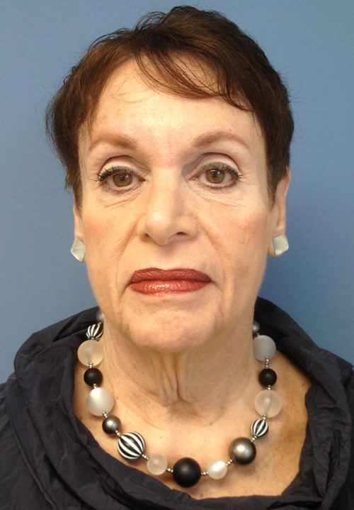 Face & Neck Lift Case 858 Before Photo Face & Neck Lift