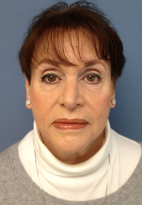 Face & Neck Lift Case 858 After Photo Face & Neck Lift