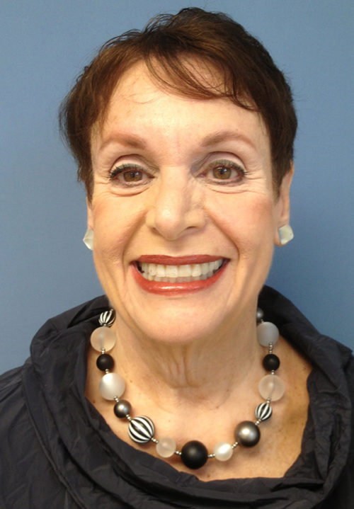 Face & Neck Lift Case 858 Before Photo Face & Neck Lift