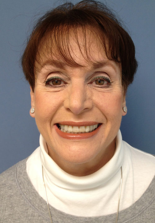 Face & Neck Lift Case 858 After Photo Face & Neck Lift
