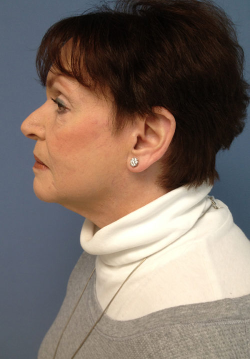 Face & Neck Lift Case 858 After Photo Face & Neck Lift