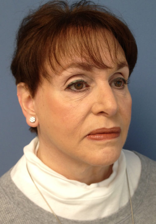 Face & Neck Lift Case 858 After Photo Face & Neck Lift