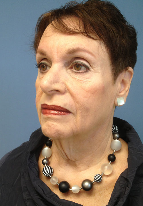 Face & Neck Lift Case 858 Before Photo Face & Neck Lift