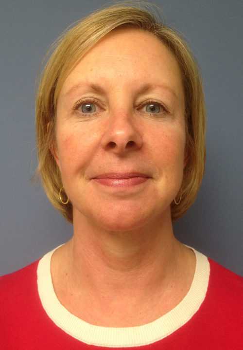 Face & Neck Lift Case 859 After Photo Face & Neck Lift