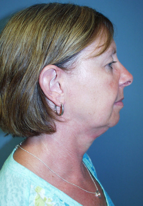 Face & Neck Lift Case 859 Before Photo Face & Neck Lift