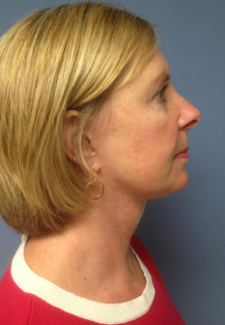 Face & Neck Lift