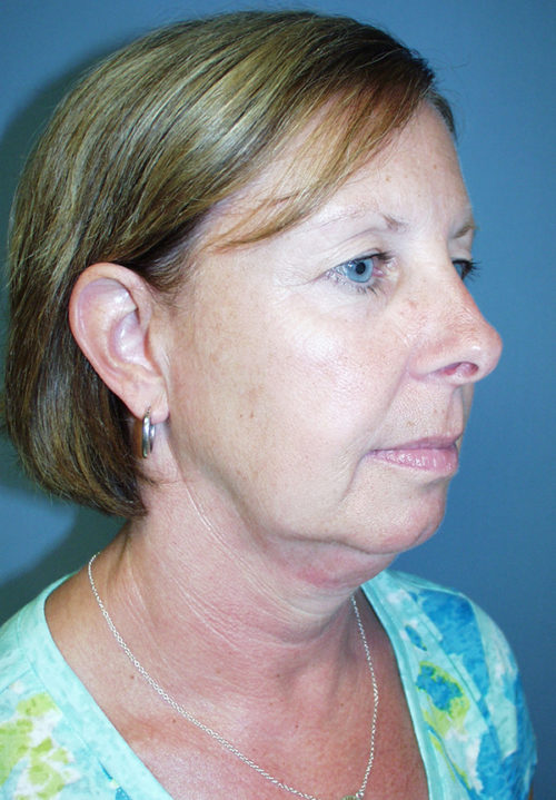 Face & Neck Lift Case 859 Before Photo Face & Neck Lift