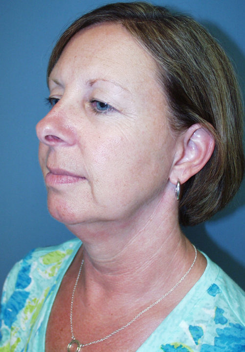 Face & Neck Lift Case 859 Before Photo Face & Neck Lift