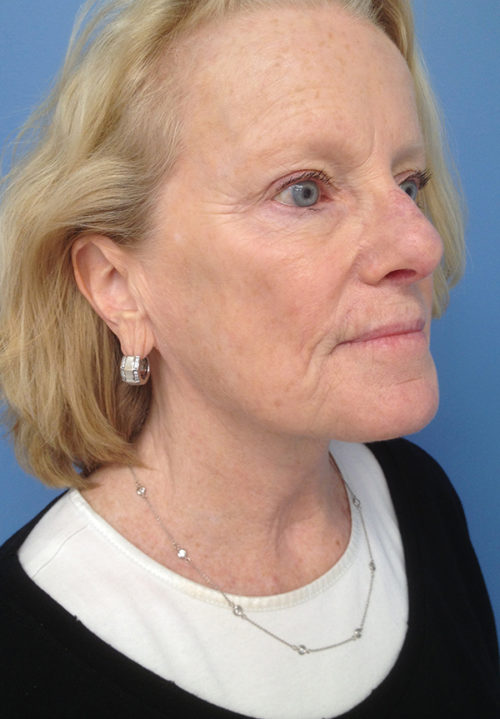 Face & Neck Lift Case 860 After Photo Face & Neck Lift