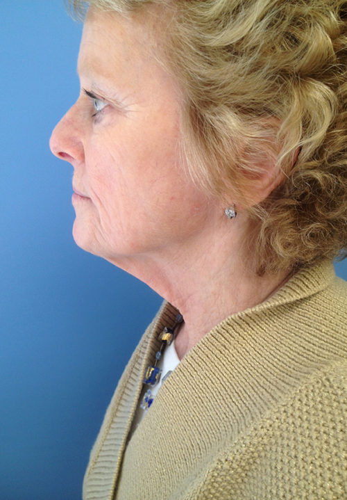 Face & Neck Lift Case 860 Before Photo Face & Neck Lift