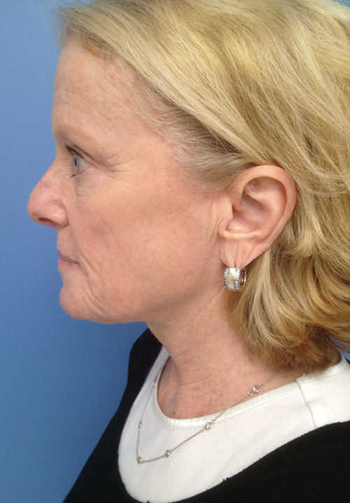 Face & Neck Lift Case 860 After Photo Face & Neck Lift