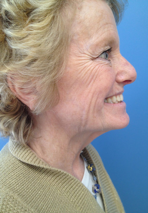 Face & Neck Lift Case 860 Before Photo Face & Neck Lift