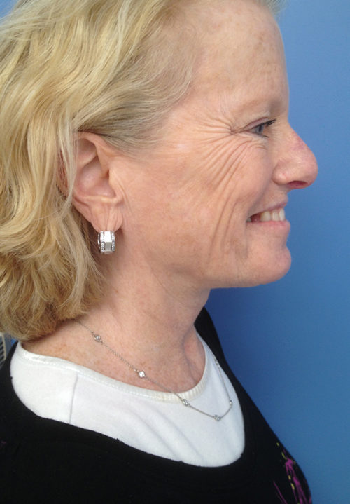 Face & Neck Lift Case 860 After Photo Face & Neck Lift
