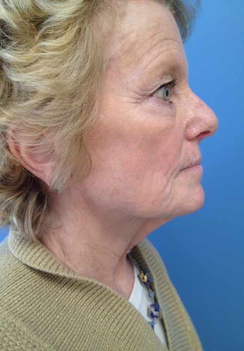 Face & Neck Lift Case 860 Before Photo Face & Neck Lift