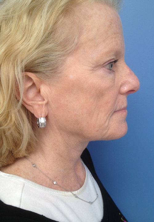 Face & Neck Lift Case 860 After Photo Face & Neck Lift
