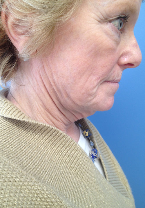 Face & Neck Lift