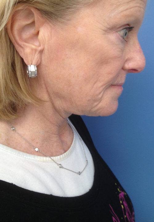Face & Neck Lift Case 860 After Photo Face & Neck Lift