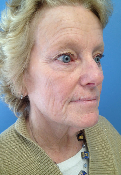 Face & Neck Lift Case 860 Before Photo Face & Neck Lift