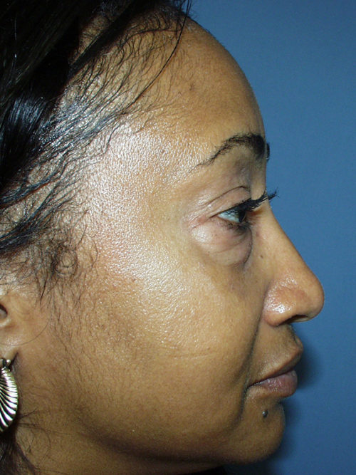 Eyelid Surgery